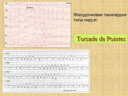 Пируэтная тахикардия