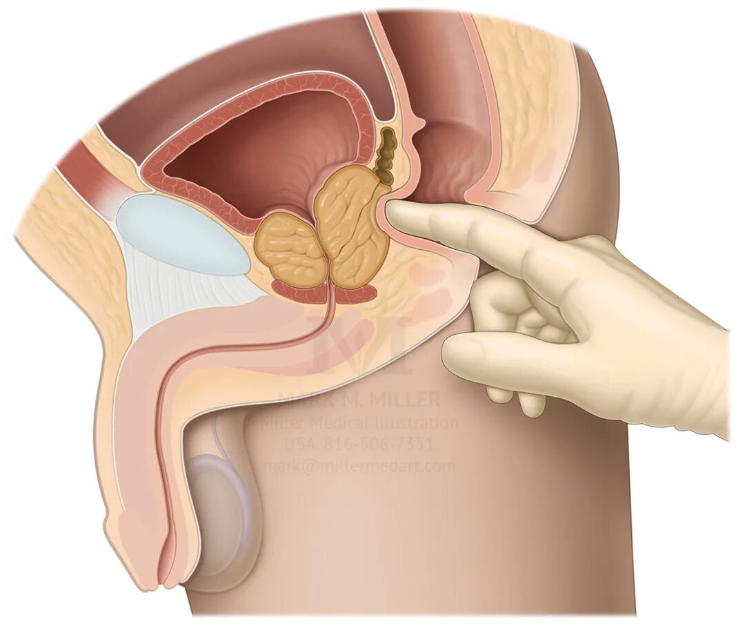 Простата у мужчин. Пальцевое исследование простаты. Ректальное исследование предстательной железы. Пальцевое ректальное исследование прямой кишки.