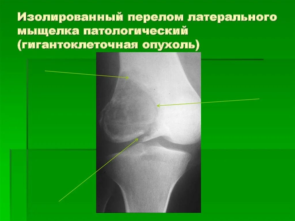 Мыщелки отек латерального мыщелка