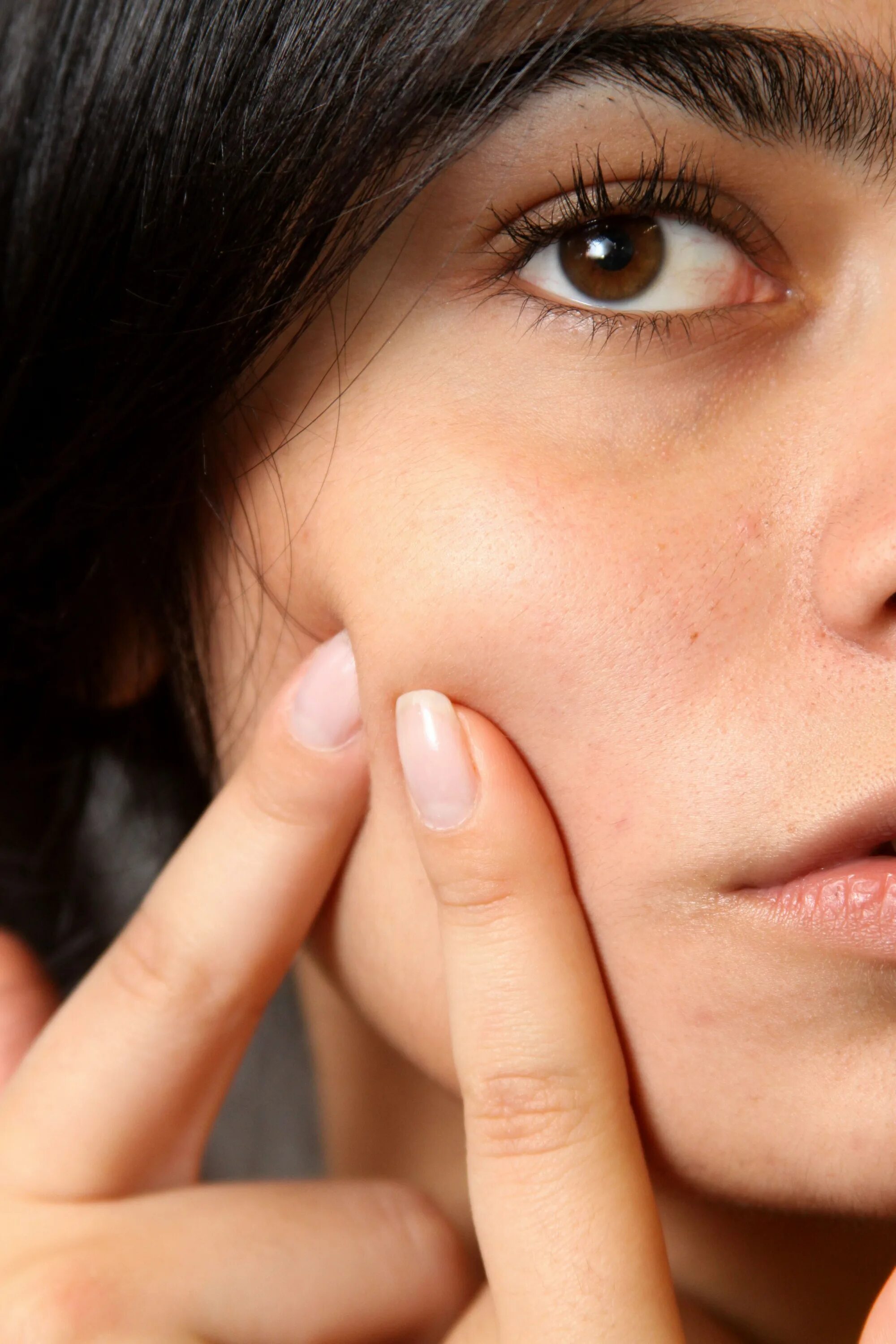 Acne pimple