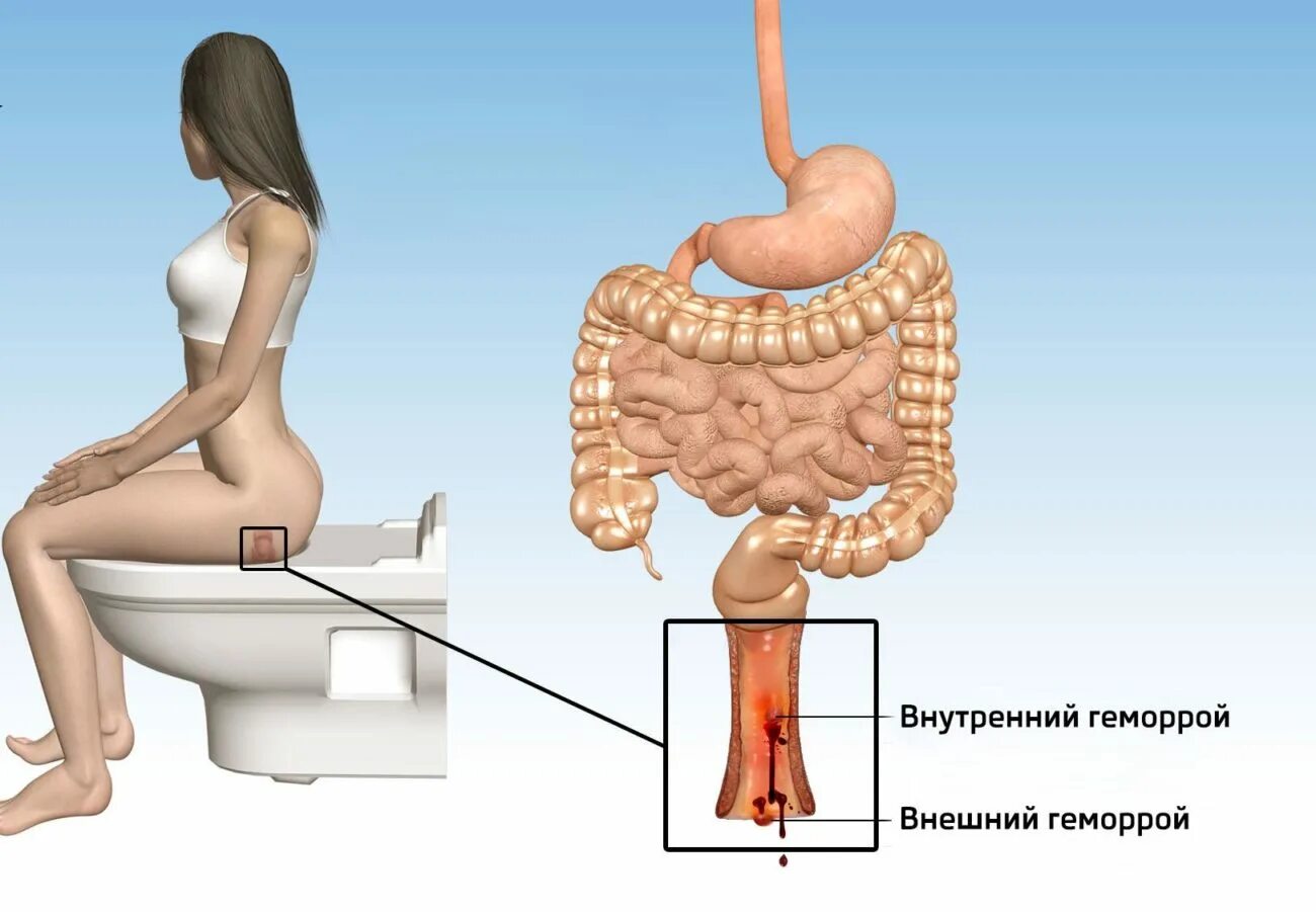 Боли в пояснице и заднем проходе. Внутренний геморроя для женщин. Внутренний геморрой симптомы.