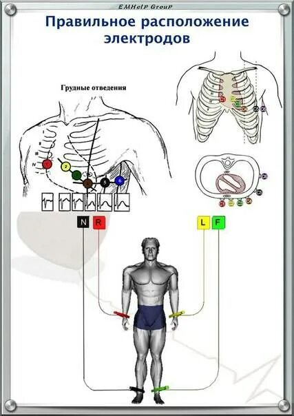 Электроды ЭКГ схема наложения. Схема наложение электродов холтера ЭКГ. Отведения ЭКГ наложение электродов. ЭКГ электроды наложение электродов. Правые грудные отведения