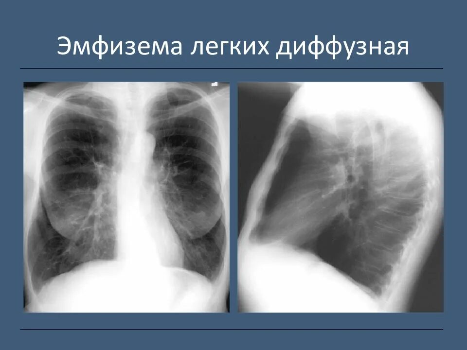 Лучевые заболевания легких. Рентген грудной клетки эмфизема. Буллезная эмфизема рентген. Обтурационная эмфизема рентген. Рентген при эмфиземе легких.