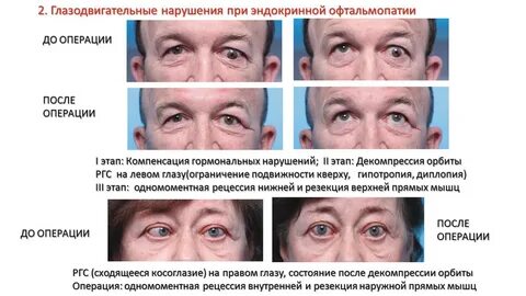 Глазной инсульт