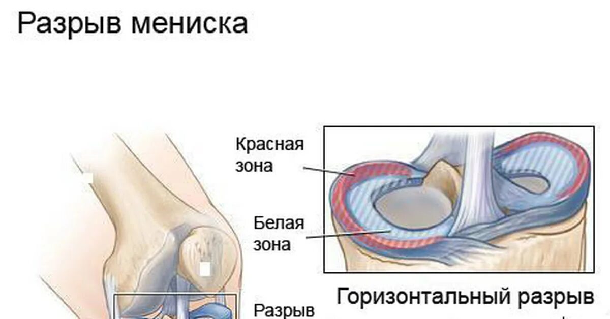 Передний рог коленного сустава. Мениск заднего рога медиального мениска степени. Разрыв медиального мениска коленного сустава 3 степени. Stoller 3b разрыв медиального мениска. Разрыв мениска коленного сустава 3 а.