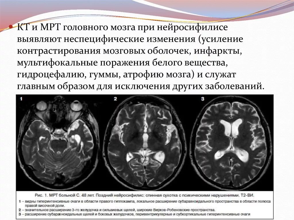 Мультифокальное поражение головного мозга мрт. Кт головного мозга при сифилисе. Нейросифилис Гумма головного мозга. Нейросифилис по мрт головного мозга. Поражение белого вещества мозга