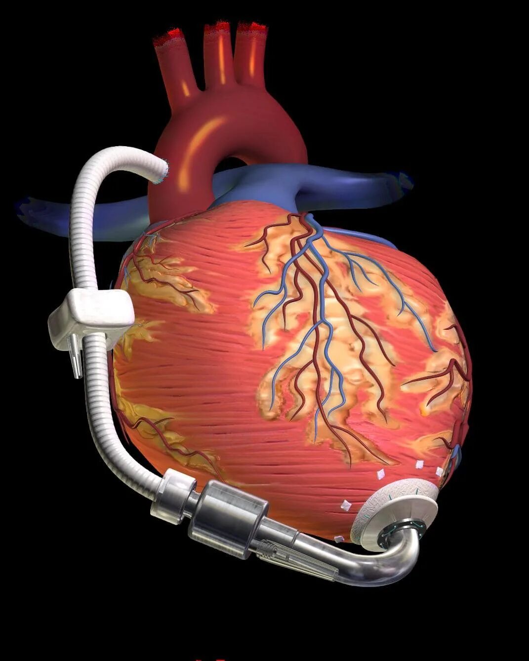 Кардиостимулятор сердца. Электрокардиостимулятор имплантируемый. Кардиовертер-дефибриллятор. Имплантируемый кардиостимулятор.