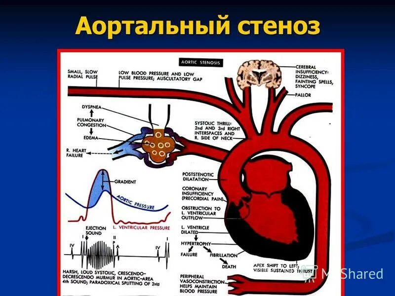 Митральный стеноз гемодинамика. Гемодинамический стеноз. Стеноз устья аорты схема. Стеноз аортального клапана схема. Гемодинамический стеноз.