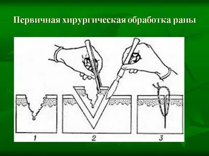 Первичная хирургическая обработка раны виды