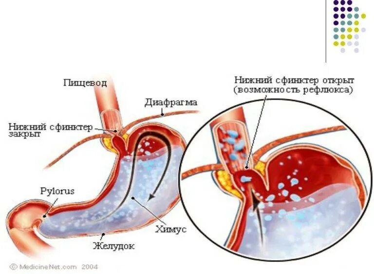 Гастроэзофагеальная рефлюксная болезнь. Вода из желудка уходит