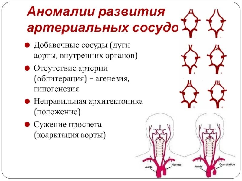 Основные аномалии развития. Аномалии развития магистральных артерий и вен головы и шеи. Аномалии развития аорты. Аномалии основной артерии.