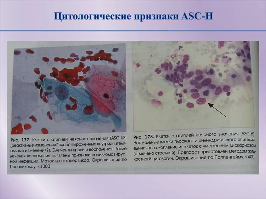 Гиперкератоз цитология мазка. Цитологическое исследование гинекологических мазков. Цитологическое исследование на атипичные клетки. Цитология клетки мазок. Nilm цитология что это такое