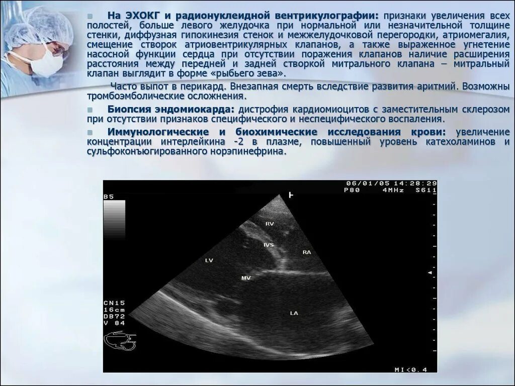 Рестриктивная кардиомиопатия ЭХОКГ. Миокардит на ЭХОКГ. Миокардит на ЭХОКГ признаки. ЭХОКГ при миокардите. Диффузные изменения лж