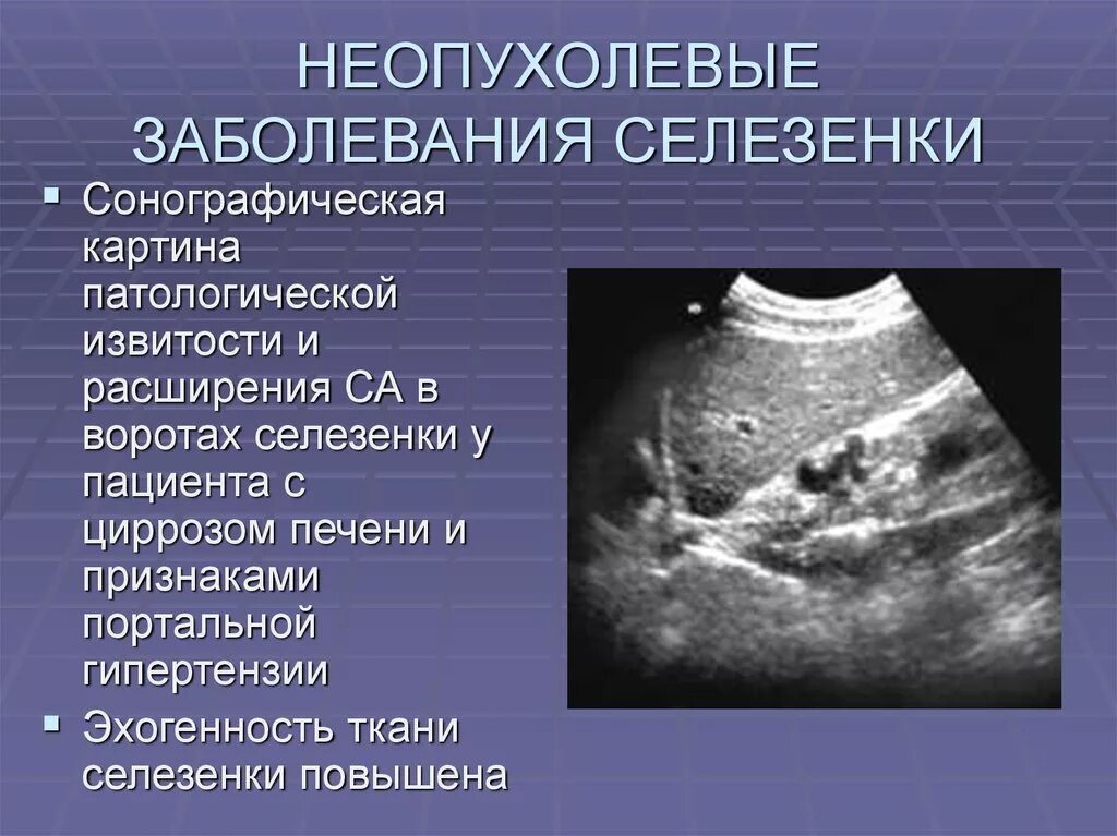 Селезенка симптомы заболевания. Спленомегалия заболевания. УЗИ картина заболеваний селезенки.