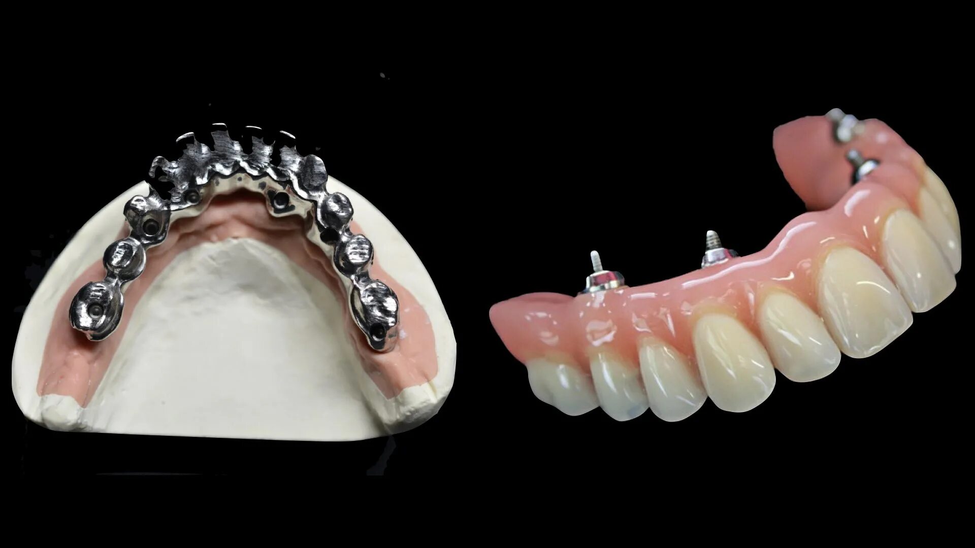 Несъемные зубные протезы на 4 имплантах. All on 4 Nobel Parallel армированный протез. Несъемные протезы на имплантатах. Несъёмные зубные протезы на 4.