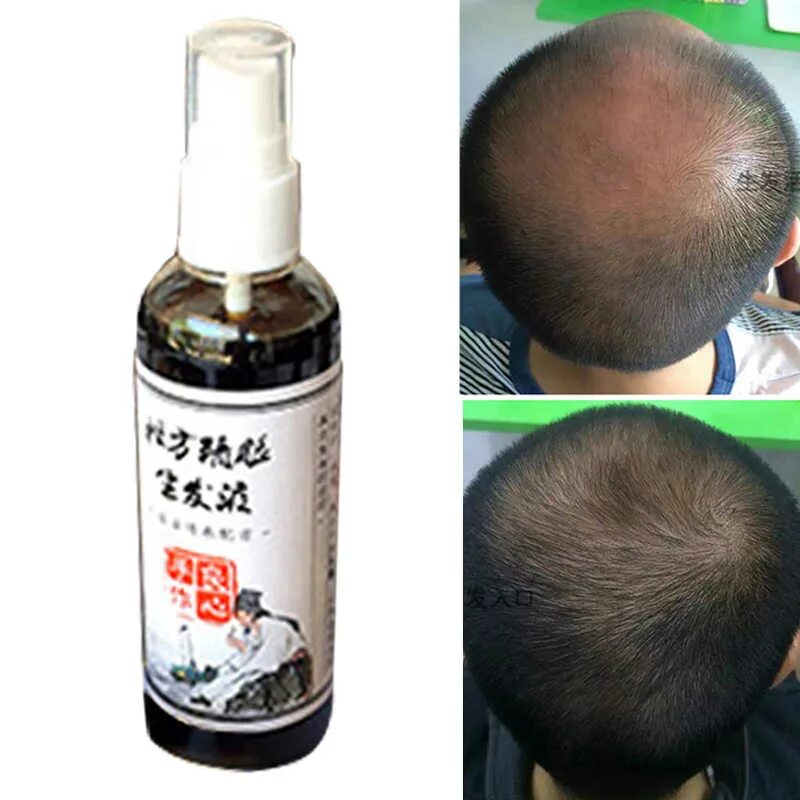 плазмолифтинг для волос. Minoxidil serum для волос. от облысения для роста волос. здоровые мужские волосы. миноксидил 5 для волос для мужчин для головы.