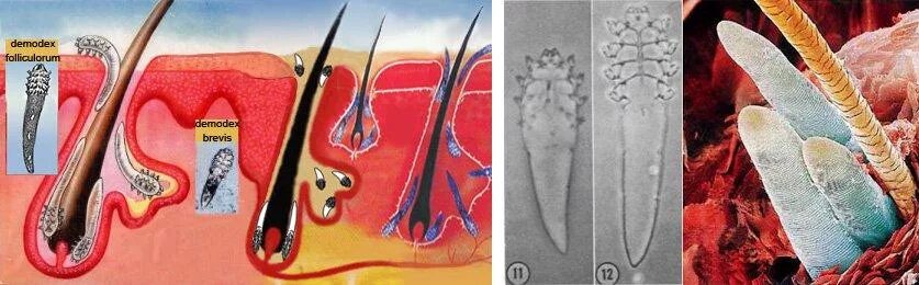 Вы ЭТО должны увидеть (фото клеща демодекс) - Demodex Complex