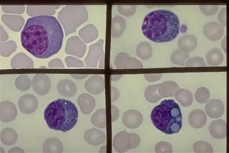 Остеосаркома цитология. Лимфоциты рисунок гистология. Кровь и элементы крови крупного рогатого скота. Мононуклеары гистология. Анизоцитоз, полихроматофилия.