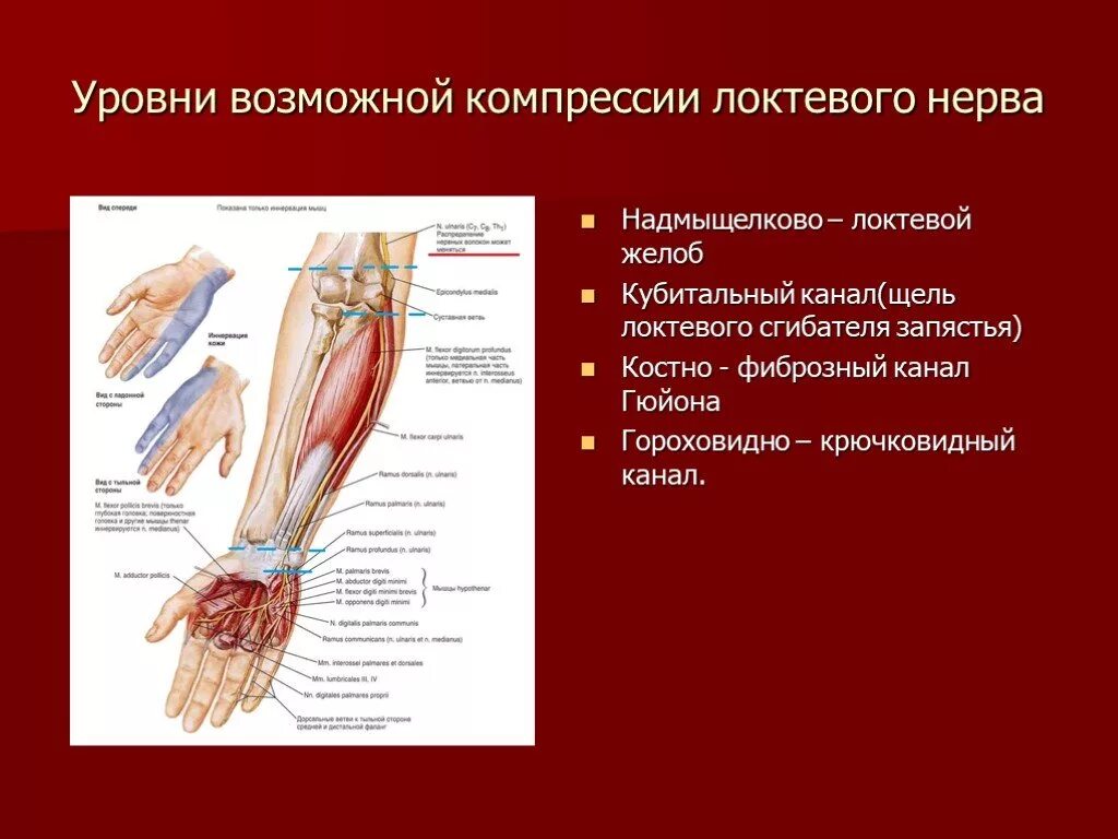 Синдром кубитального канала локтевого нерва. Плечевое сплетение локтевой нерв. Запястный синдром компрессии локтевого нерва. Компрессия локтевого нерва на уровне запястья.