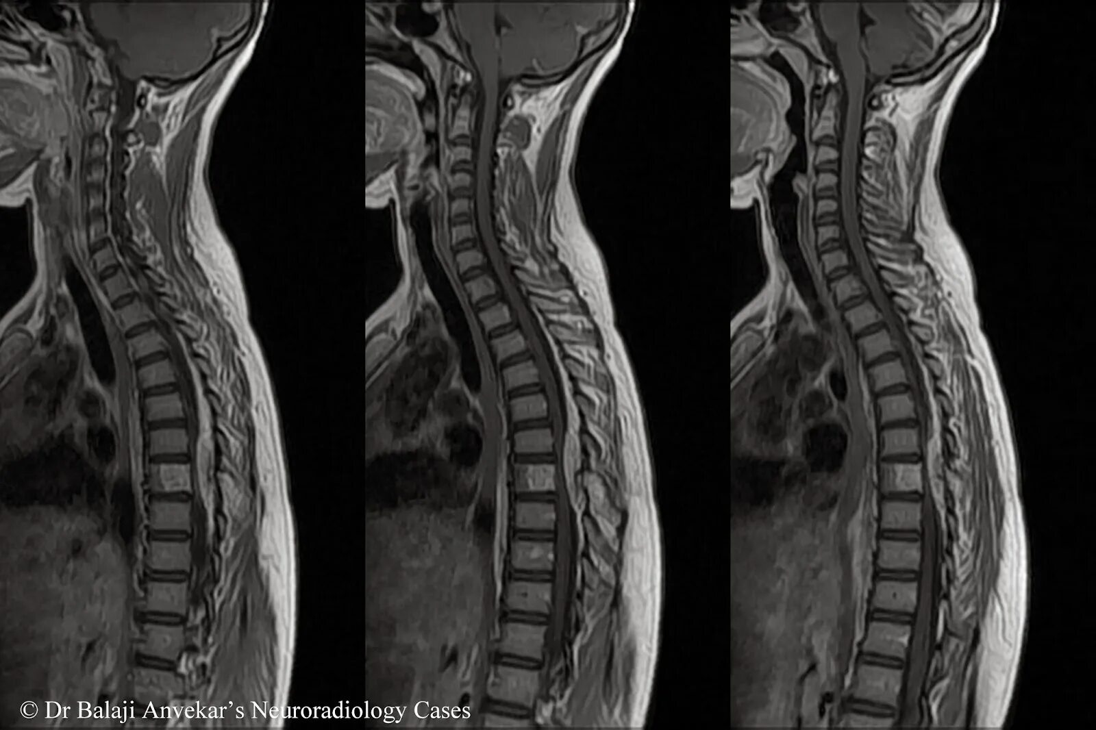 Spine mri. T1 spinal cord mri. гемангиома позвоночника корсет. веноспондилография позвоночника. гемангиома эпидуральная.