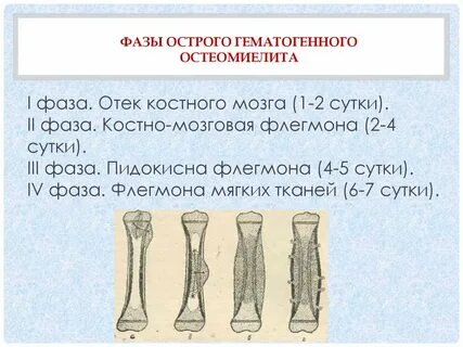 Костная острая