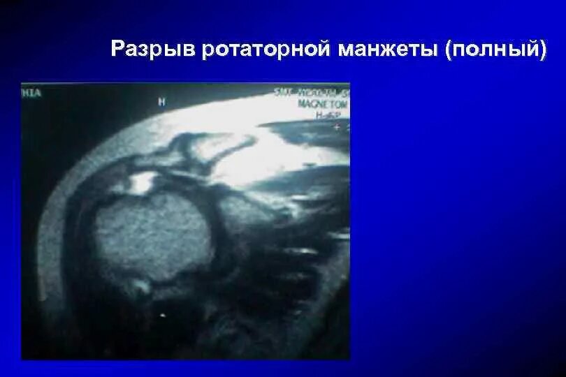 Повреждение вращательной манжеты мкб. Повреждение вращательной манжеты мкб