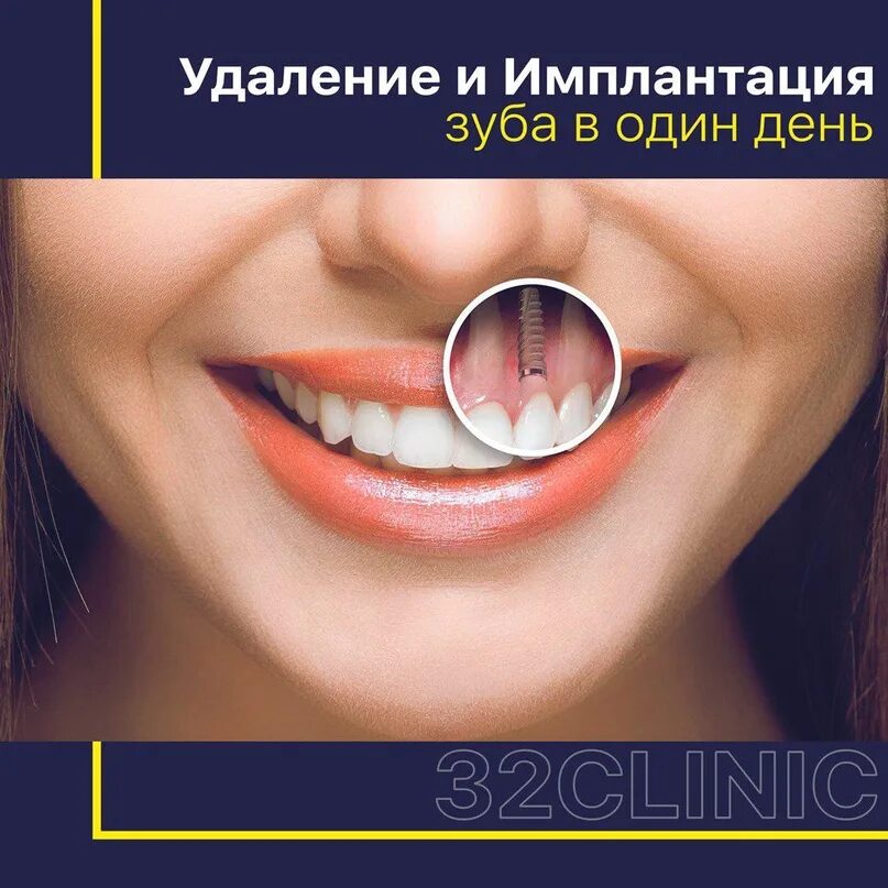 Через сколько можно вставлять зубы. Резекция переднего зуба. Имплантат переднего зуба.