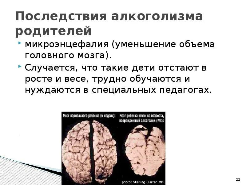 Объем головного мозга наибольшее. Последствия алкоголизма. Осложнения алкоголизма. Алкогольные последствия.