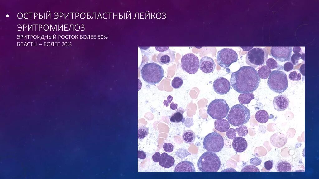 Мозг при остром лейкозе. Острый эритролейкоз картина крови. Острый эритромиелобластный лейкоз. Хронический эритробластный лейкоз. Острый эритромиелоз картина крови.