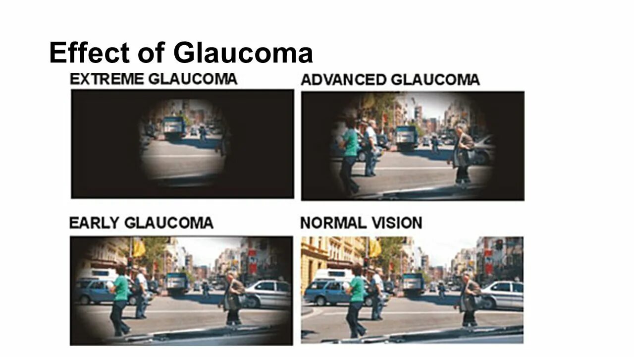 Зрение 12 как видит. Зрение при глаукоме. Как видит человек с глаукомой. Как видит человек при Глауко. Как видит человек пригоаукоме.