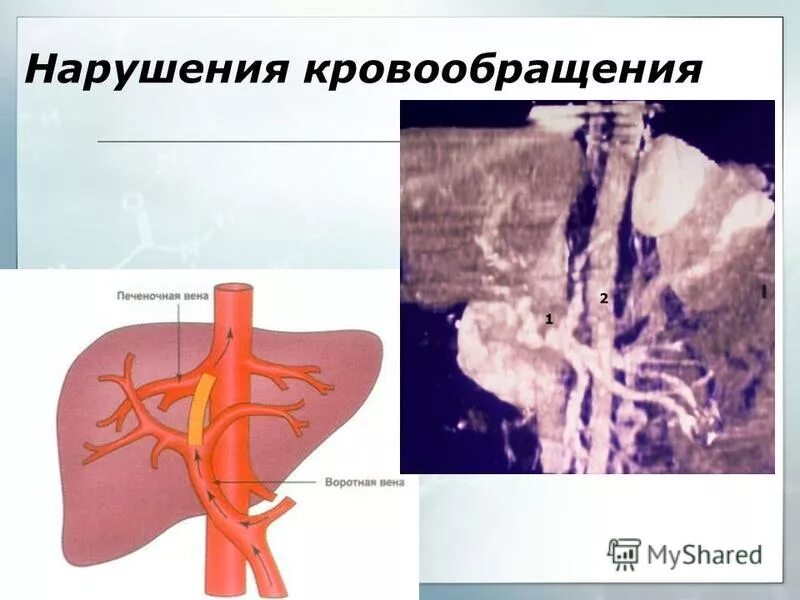 Нарушение общего кровообращения