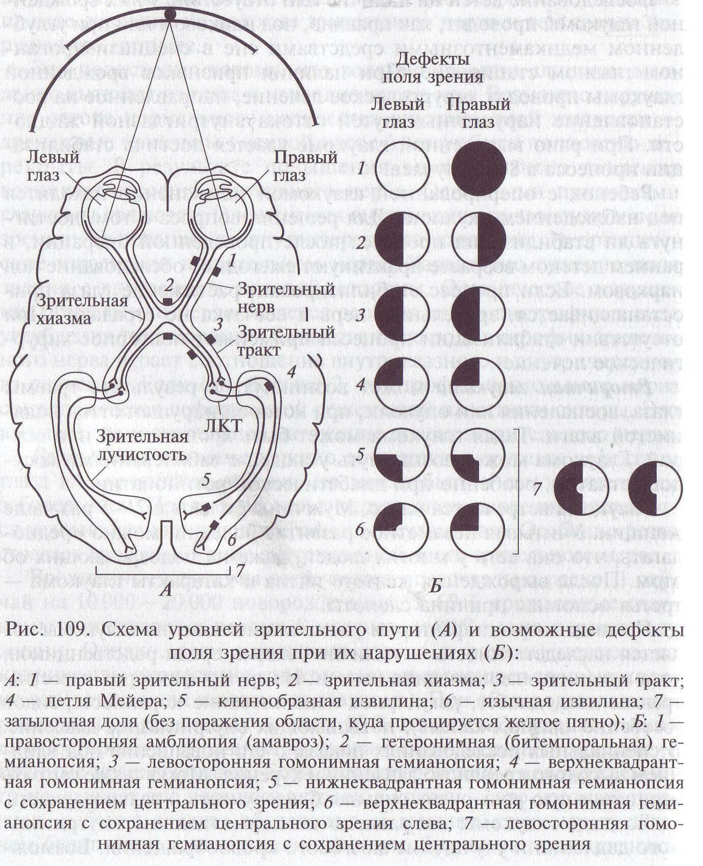 Ход волокон зрительного нерва. Выпадение полей зрения неврология. Зрительный нерв хиазма зрительный тракт. Выпадение полей зрения схема. Какой глаз левый а какой правый