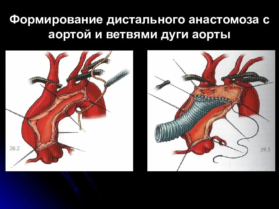 Формирование аорты. Окклюзионные поражения ветвей аорты. формирование анастомоза. дуга аорты.