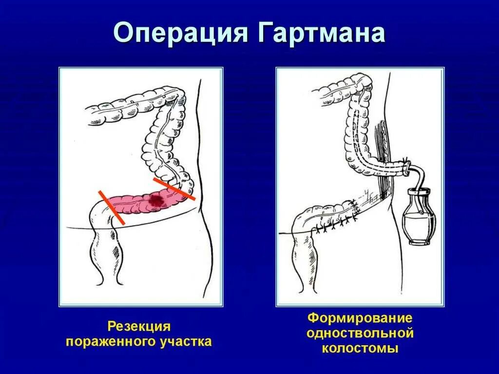 Операция толстой. Операция Гартмана на толстой кишке. Колостома операция Гартмана. Операция Гартмана на сигмовидной кишке. Резекция толстой кишки по Гартману.