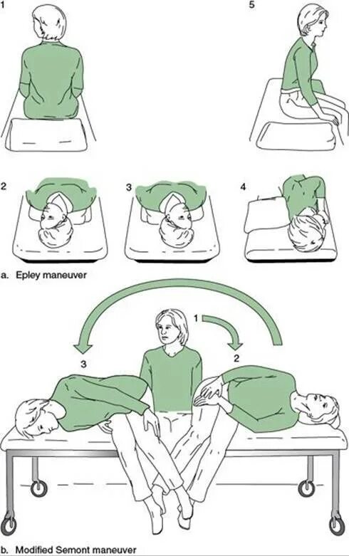 Упражнения брандта при головокружении. Вестибулярная гимнастика упражнения Брандта Дароффа. Маневр Брандта-Дароффа. Маневры Эпли при головокружении. Вестибулярная гимнастика маневр Эпли.