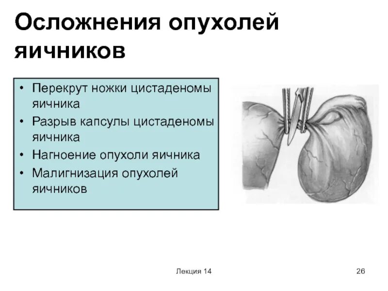 Перекрут ножки кисты яичника. Перекрут яичника симптомы.