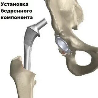 Шейка тазобедренного сустава операция