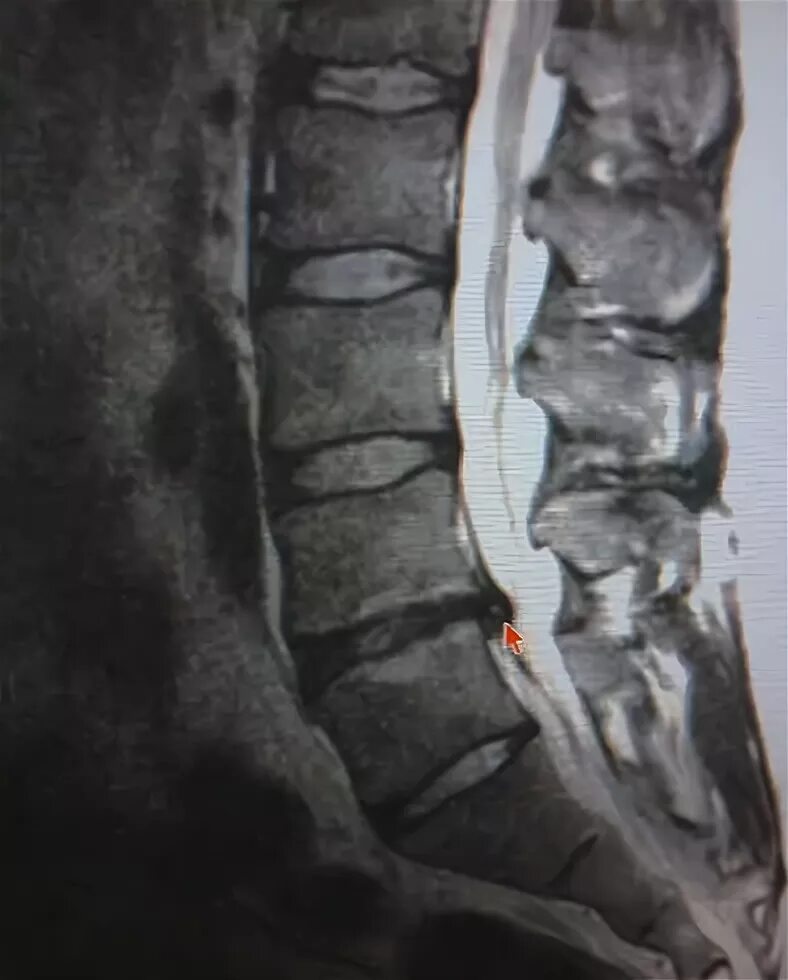Остеохондроз поясничного отдела l5 s1. Остеохондроз l4-5 l5-s1 поясничного. Остеохондроз l5-s1. Остеохондроз поясничного отдела на снимке мрт. Люмбоишиалгия на мрт.