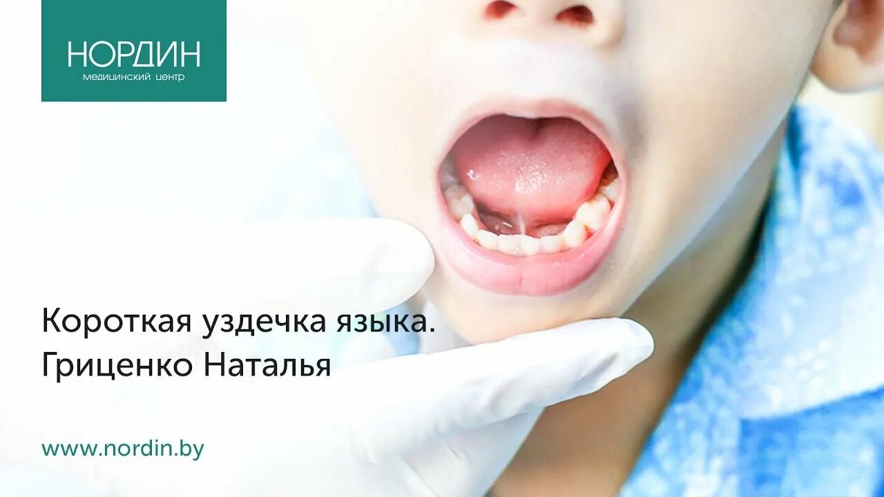 Короткая уздечка под языком у ребенка! Как определить и помочь? - YouTube