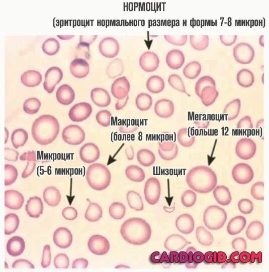 Патологические формы эритроцитов. Анизоцитоз, морфология эритроцитов. анизоцитоз лейкоцитов. анизоцитоз макроциты. анизоцитоз и пойкилоцитоз эритроцитов.