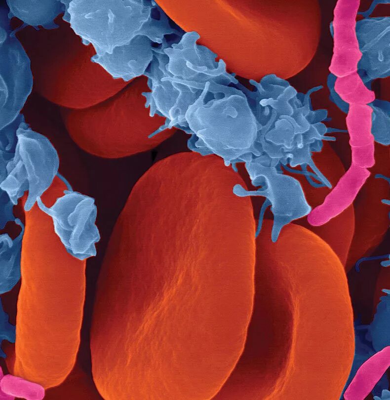 Уросепсис. Одонтогенный сепсис возбудитель. Микроб сепсис. Стрептококковая бактериемия. Микроб сепсис.