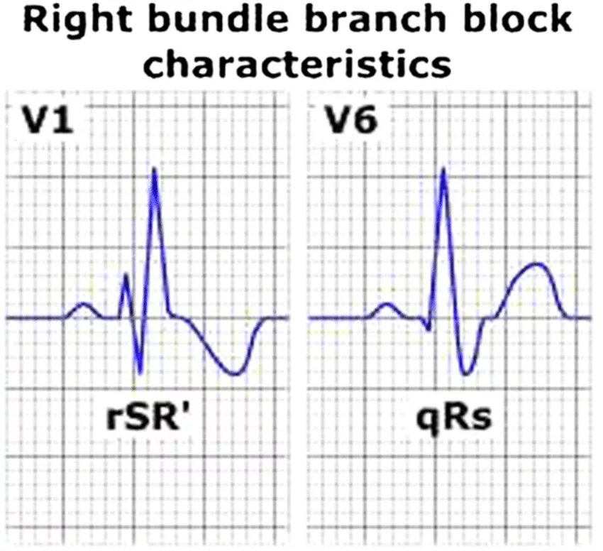 Блокада qrs. Комплекс QRS В v1 типа RSR’. Комплекс QRS при блокаде пучка Гиса. Right Bundle Branch Block ЭКГ. RSR на ЭКГ.