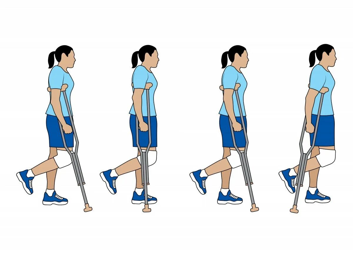 Бесплатное передвижение. Ходьба на костылях. Ходьба на локтевых костылях. Техника ходьбы на костылях. Правильная ходьба на костылях.