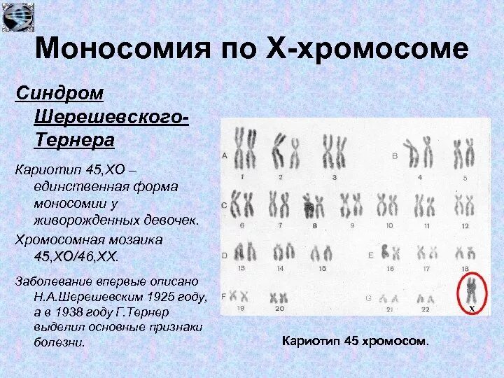 Моносомия по х-хромосоме синдром Шерешевского -Тернера кариотип 45 Хо. Синдром Шерешевского Тернера кариотип. Моносомия по х-хромосоме кариотип. Кариотип моносомия по х.