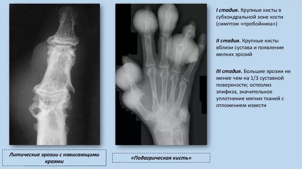 Симптомы пробойника подагра рентген. Ревматоидный артрит кисти рентген. Стадии подагрического артрита рентгенологические. Подагрический артрит 1 пальца стопы рентген. Артрит рентгенологические стадии