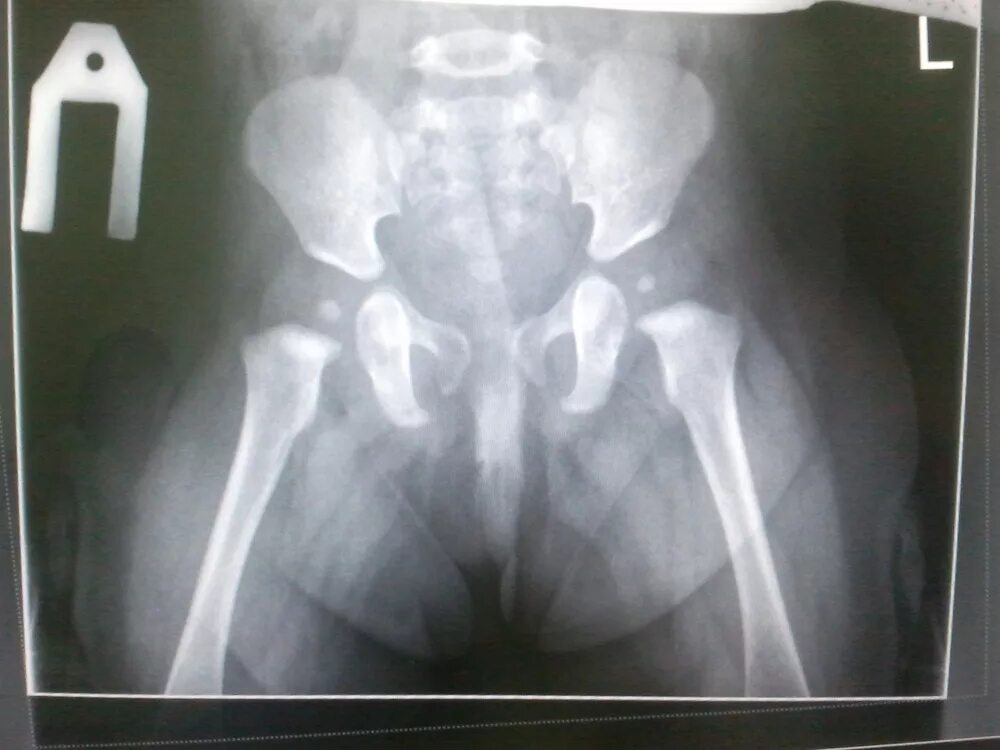 2х сторонняя дисплазия тазобедренных суставов. Как лечить дисплазию суставов. Дисплазия тазобедренных суставов 2с предвывих. Гипоплазия тазобедренного сустава. Типы дисплазии тазобедренных суставов у детей.