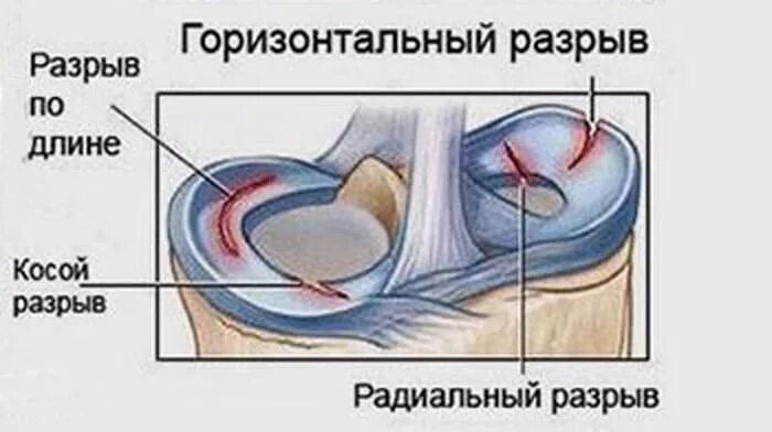 Классификация Stoller повреждения менисков коленного сустава. Горизонтальный разрыв заднего рога медиального мениска. Классификация разрывов мениска Stoller. Мениск коленного сустава разрыв медиального мениска.