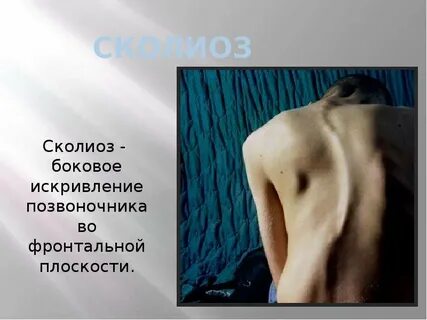 Боковое искривление