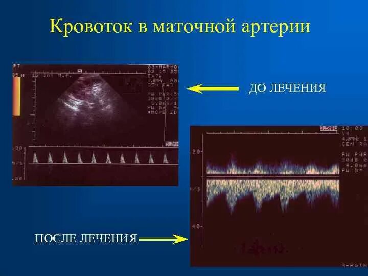 Кроанток в матосных артеричх. Кровоток в маточных артериях. Нарушение кровотока в маточной артерии. Кровоток в маточных артериях норма. Маточная гемодинамика