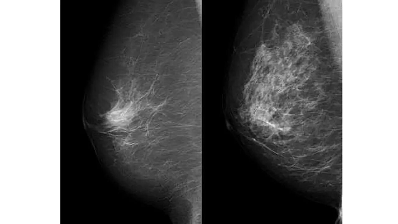 Фиброаденоматоз рентген маммография. Узловая мастопатия маммограмма. Протоковая карцинома молочной железы. Болезнь Педжета маммография. Онкология молочных желез симптомы